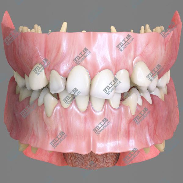 images/goods_img/20210312/Permanent Dentition with Braces/5.jpg